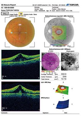 網膜黄斑浮腫の画像3D